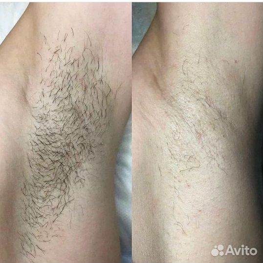 Электроэпиляция