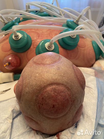 Массаж вакуумный, висцеральный, обучение хиджаме