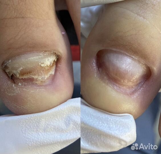 Подолог / медицинский педикюр