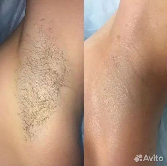Лазерная эпиляция
