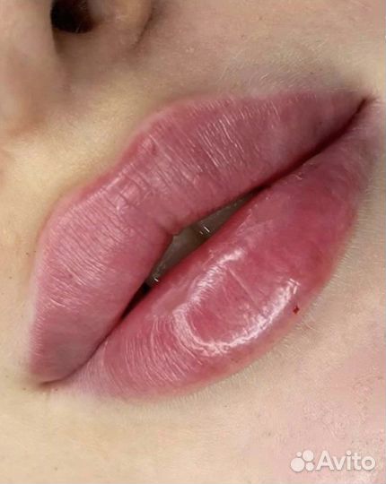 Увеличение губ, скулы, ботокс, плазмолифтинг