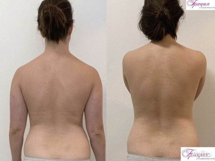 LPG массаж тела и лица Кей Модуль