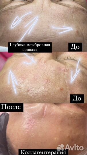 Биоревитализация