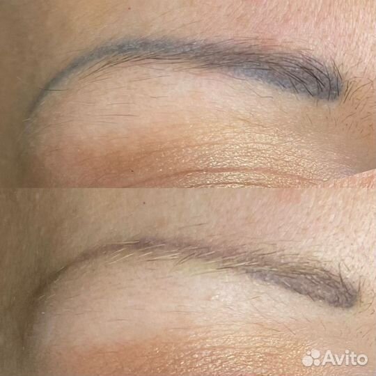 Удаление татуажа лазером