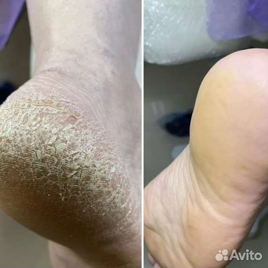 Сегодня есть окошки Педикюр на реклайнере