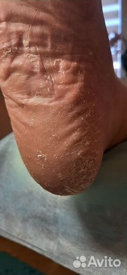 Медицинский педикюр,подолог