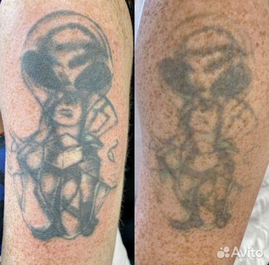 Полное удаление тату в спб