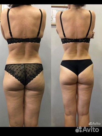 Антицеллюлитный массаж коррекция фигуры