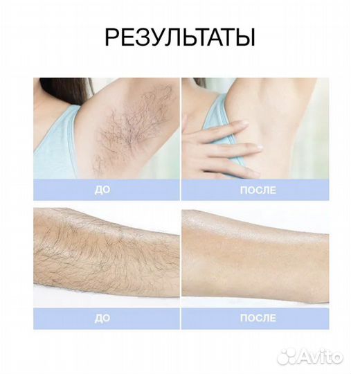 Лазерный эпилятор IPL