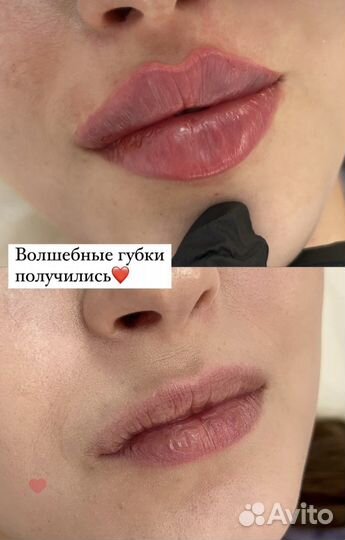 Увеличение губ