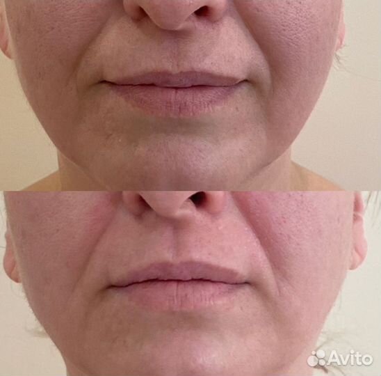 Холодная плазма