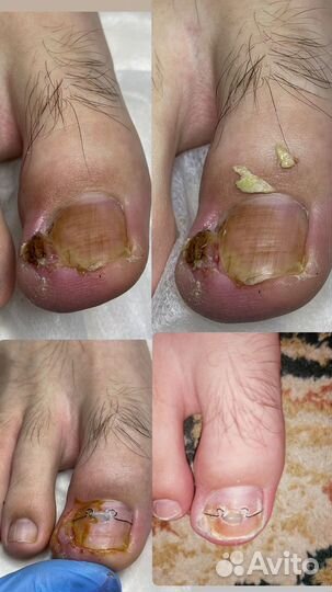 Подолог. Вросший ноготь. Титановая нить