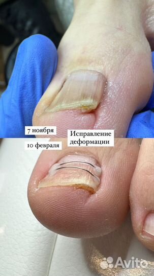 Лечебный педикюр, подолог