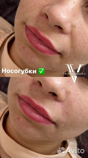 Носогубные складки