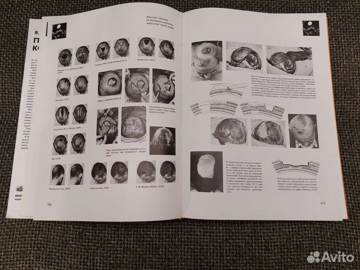 Я. Золтан - Пересадка Кожи. Состояние Люкс