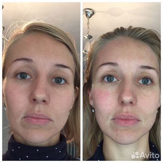 Скульптурно-буккальный массаж, уход за лицом