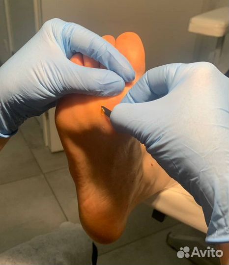 Удаление бородавок на стопах, подолог