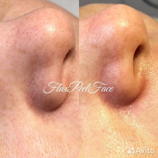 Атравматическая чистка лица