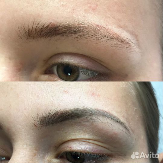 Удаление татуажа лазером