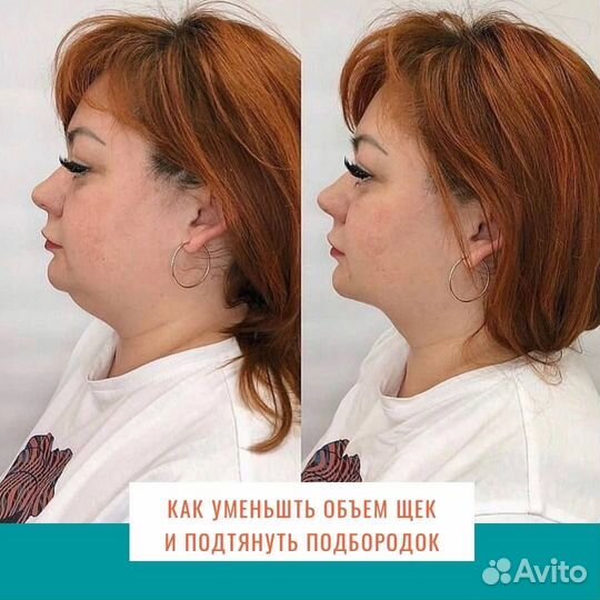 Модель на смас лифтинг