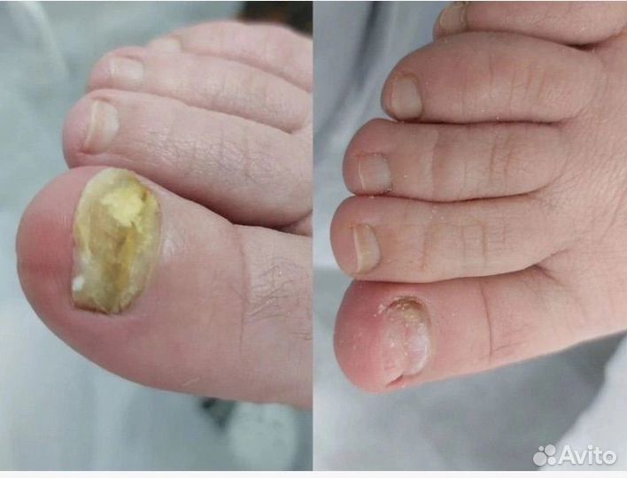 Услуги подолога, парамедицинский педикюр