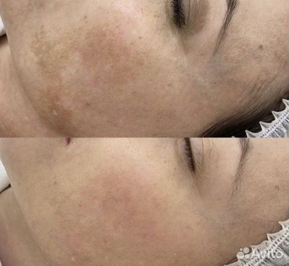 Удаление пигментных пятен