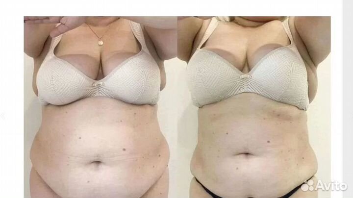 Плоский живот - размер за 1 процедуру Рост на Дону