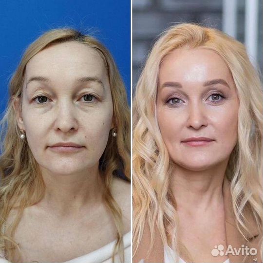 Элос Омоложение и Эпиляция