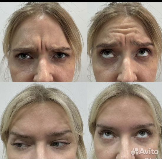 Ботокс для лица и тела/ Фулл Фейс