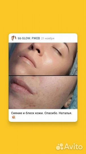 Фракционная мезотерапия bb glow безинъекционная