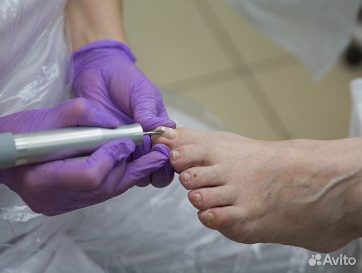 Медицинский (лечебный) педикюр - Подолог