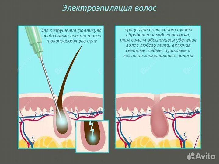 Электроэпиляция