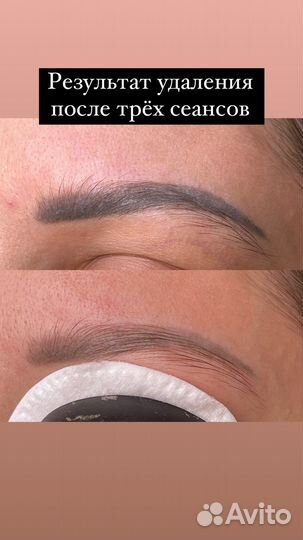 Удаление татуажа бровей, губ, татуировок
