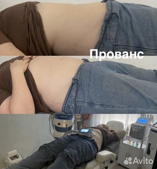 Криолиполиз