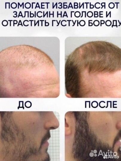 Миноксидил 25 для роста волос и бороды