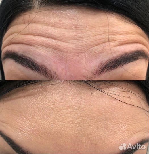 Ботокс (Бутулинотерапия) botox