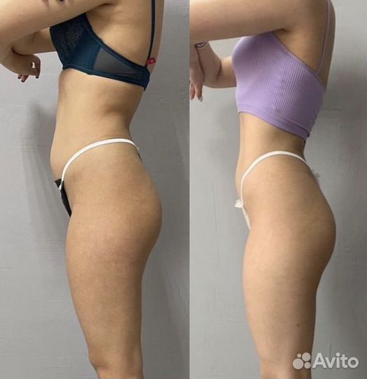 Вакуумный массаж Турбомассаж коррекция фигуры