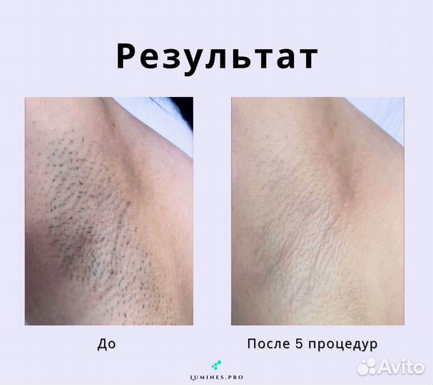 Аппарат для эпиляции Lumines. Макс Ван 1200W