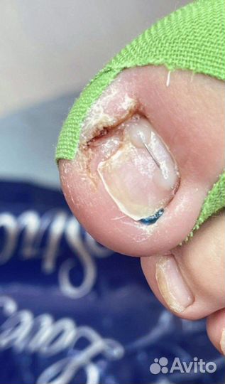 Подолог.Вросший ноготь.Грибок.Мозоль.Бородавки