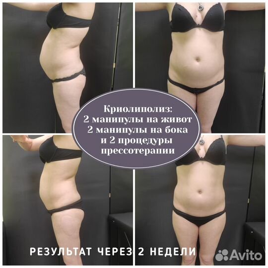 Модель на криолиполиз, вакуумный массаж, кавитация