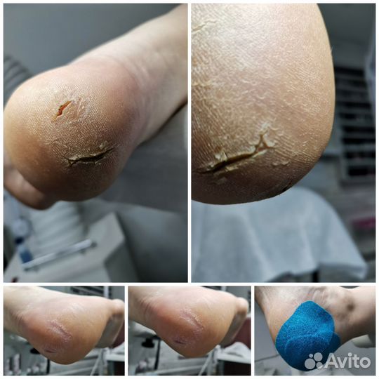 Подологический педикюр