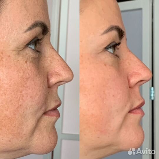 Скульптурный массаж лица. Буккальный