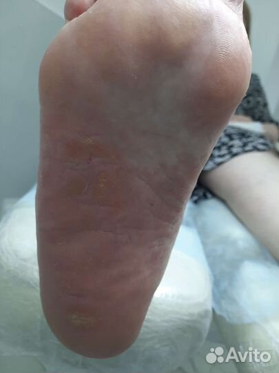 Педикюр медицинский (подолог)с выездом на дом