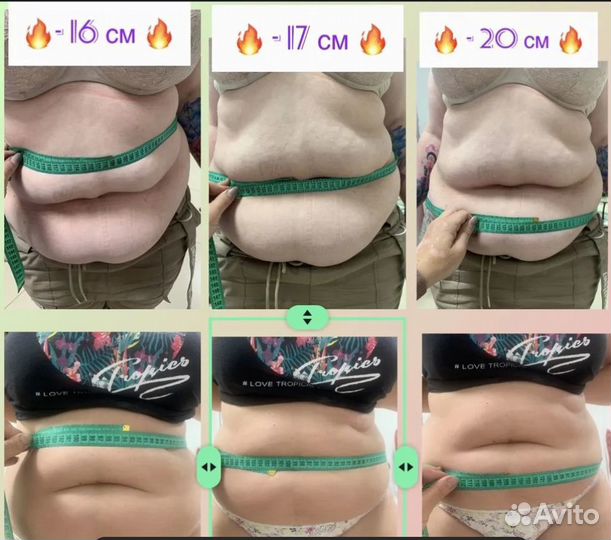 Новая технология похудения Криолиполиз