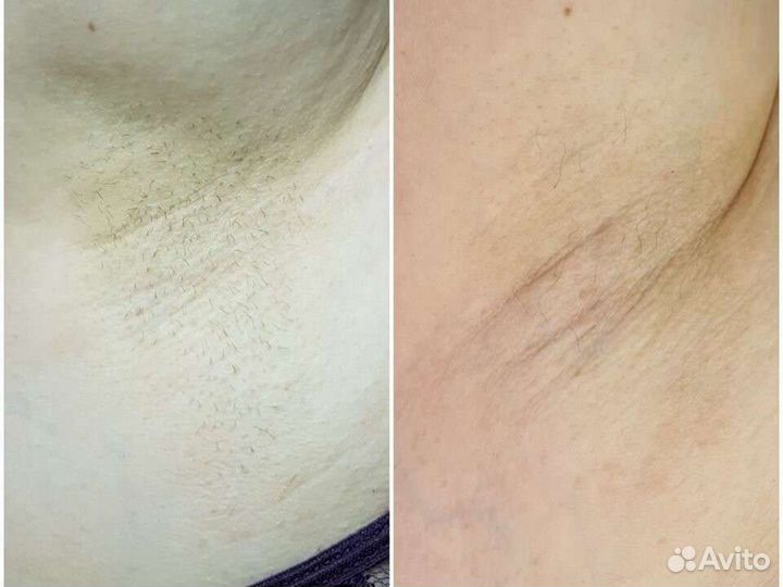 Электроэпиляция Нальчик