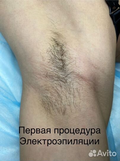 Электроэпиляция