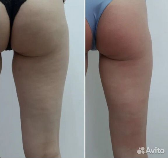 Аппаратный массаж turbo