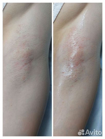 Электроэпиляция