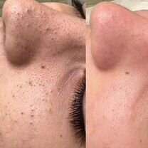 Косметолог чистка лица