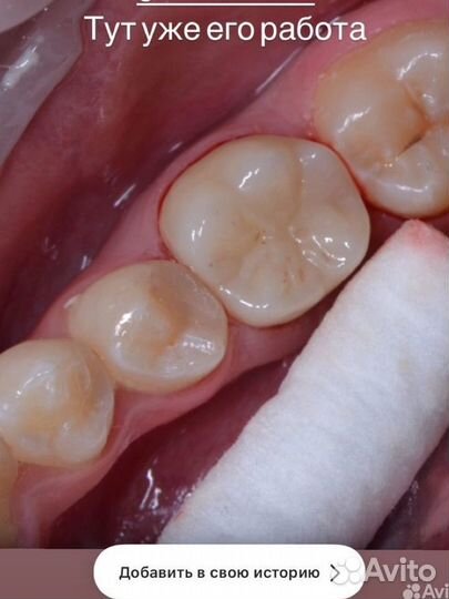 Зубной техник. Коронки, Виниры (Емах, Циркон)